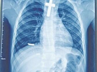 Unique case: Supercare Hospital remove crucifix from girl’s throat