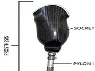 Two amputees from M’laya get customised prosthetic legs under NEC initiative