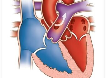 Rare lifesaving heart surgery performed at NEIGRIHMS