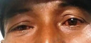 Ri Bhoi headmen concern over conjunctivitis surge