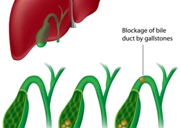 6 Gallstones Symptoms To Know