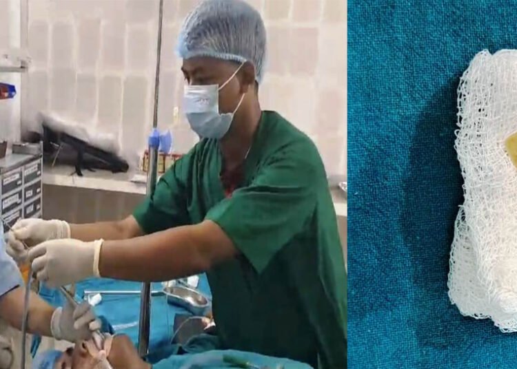 Mawkyrwat doctors fish bony flap from throat of a man