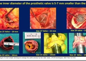 NEIGRIHMS performs first ‘Bo-Yang Y-Incision’ on patient with aortic valve disease