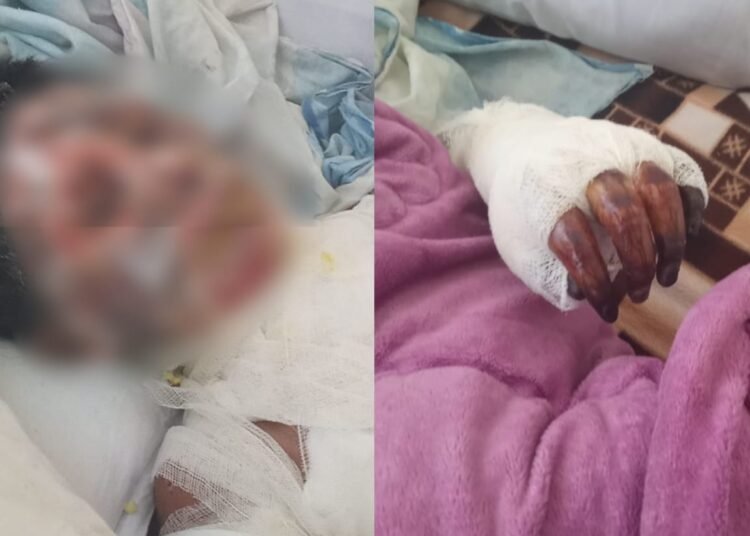 Domestic violence comes to fore, wife burnt by husband