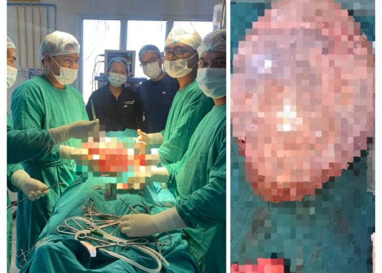 5.7 kg tumour removed from 50-year-old woman in Mawkyrwat Civil Hospital