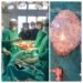 5.7 kg tumour removed from 50-year-old woman in Mawkyrwat Civil Hospital