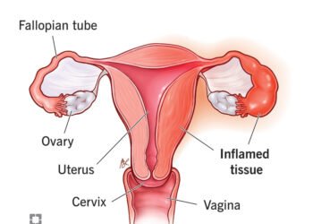Pelvic Inflammatory Disease: The Hidden Enemy of Women’s Reproductive Health