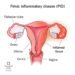 Pelvic Inflammatory Disease: The Hidden Enemy of Women’s Reproductive Health