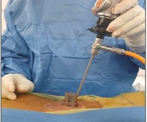 NEIGRIHMS doctors successfully perform endoscopic spine surgery