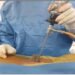 NEIGRIHMS doctors successfully perform endoscopic spine surgery
