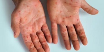 Risk of measles outbreak spurs health authorities into action