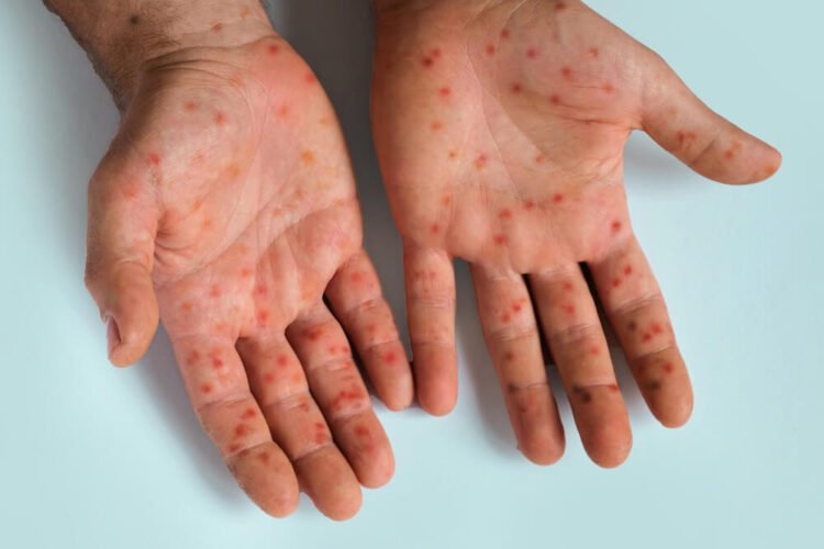 Risk of measles outbreak spurs health authorities into action