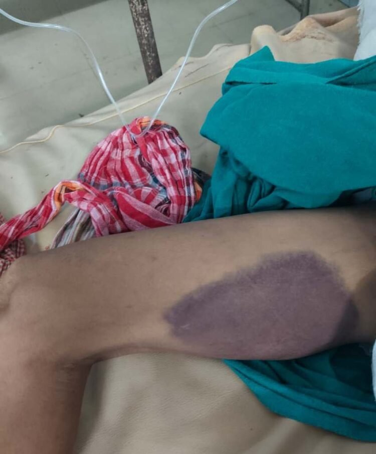 Allegations of custodial torture in bike theft case